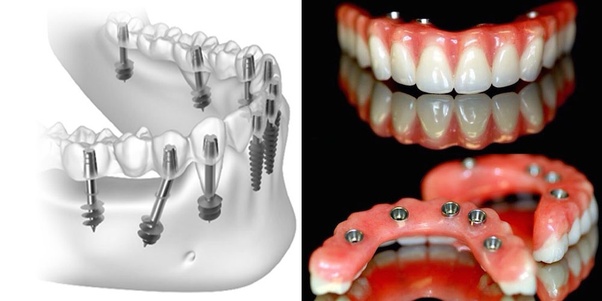 fixed teeth 3 days jalandhar