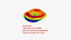 flapless bladeless lasik Silk jalandhar flapless bladeless lasik Silk jalandhar